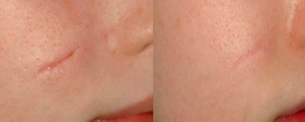 Fractional Laser Before & After