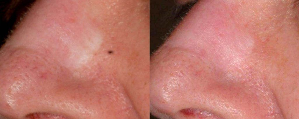 Fractional Laser Before & After