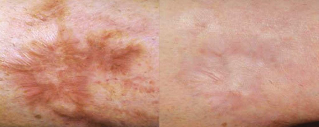 Fractional Laser Before & After