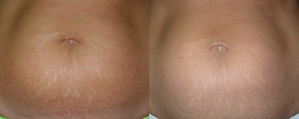 Fractional Laser Before & After