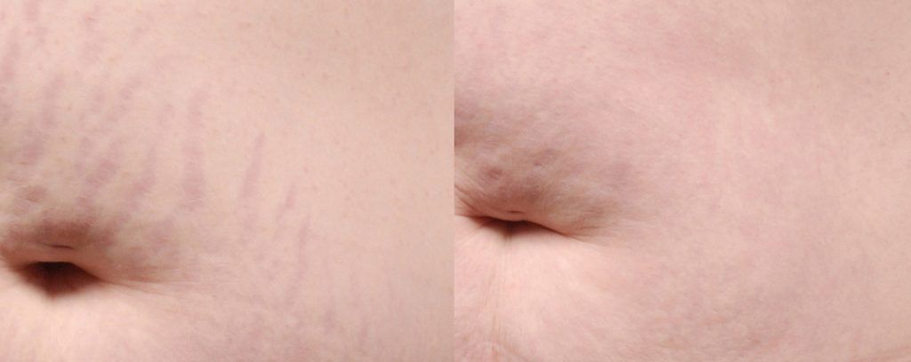 Fractional Laser Before & After