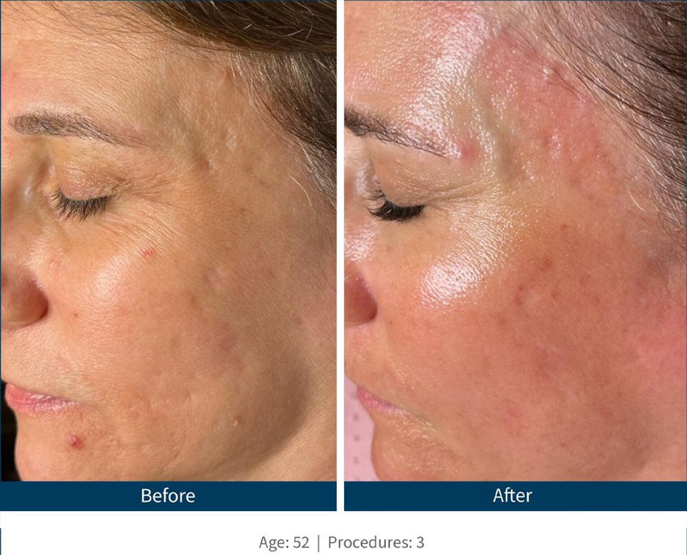 SkinPen Before & After