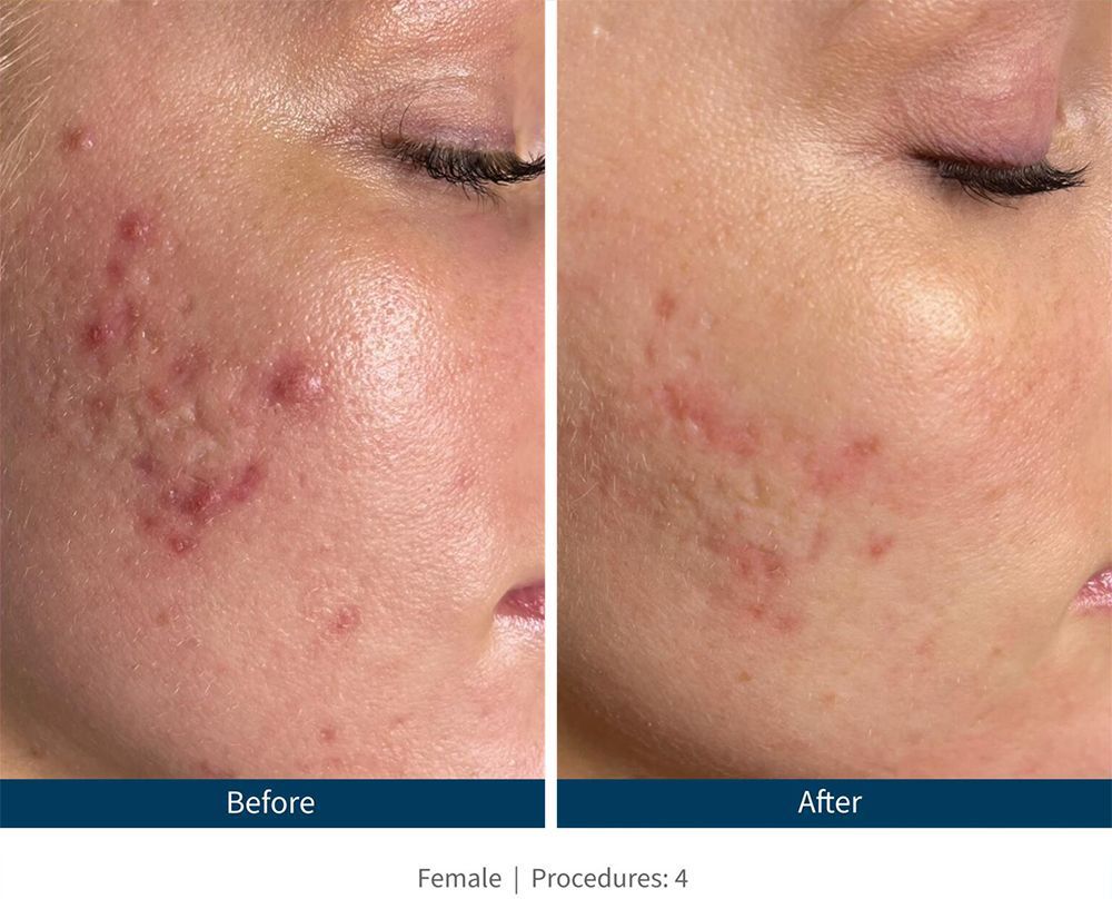 SkinPen Before & After