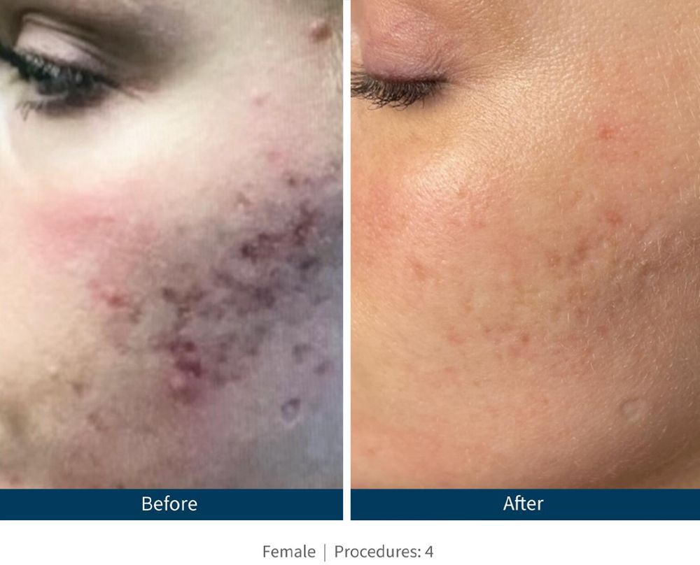 SkinPen Before & After