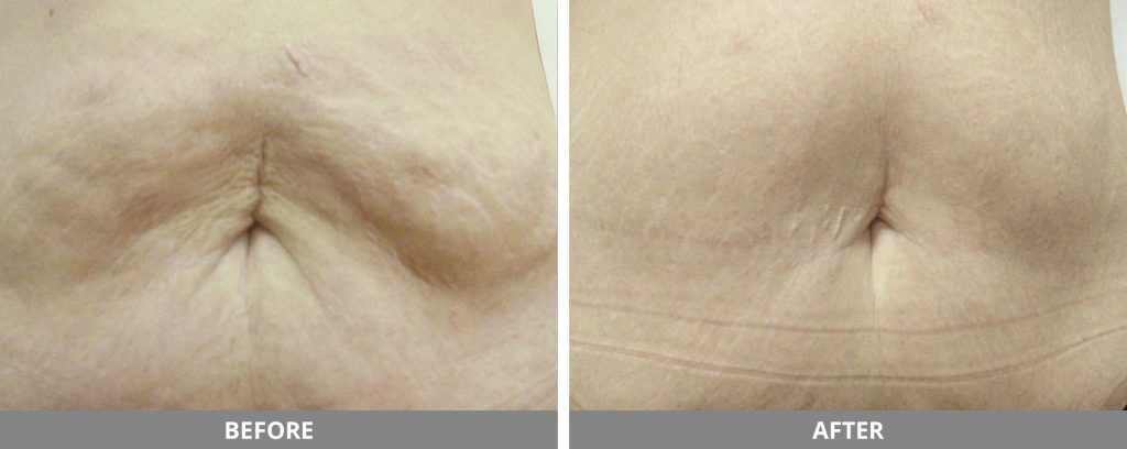 Cellulite Reduction Before & After