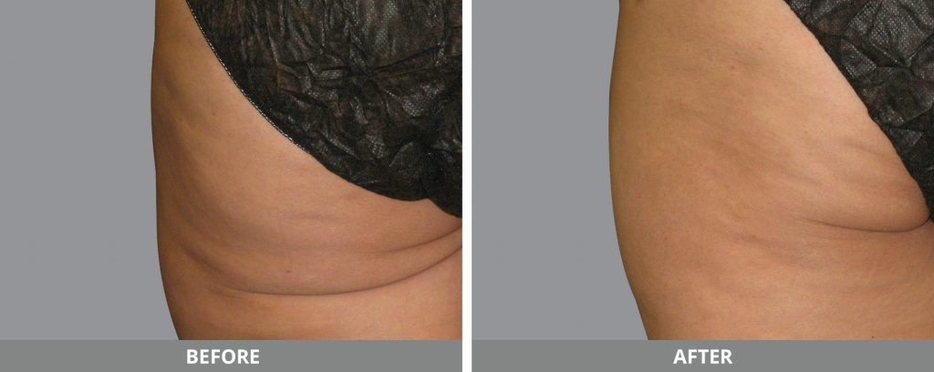 Cellulite Reduction Before & After