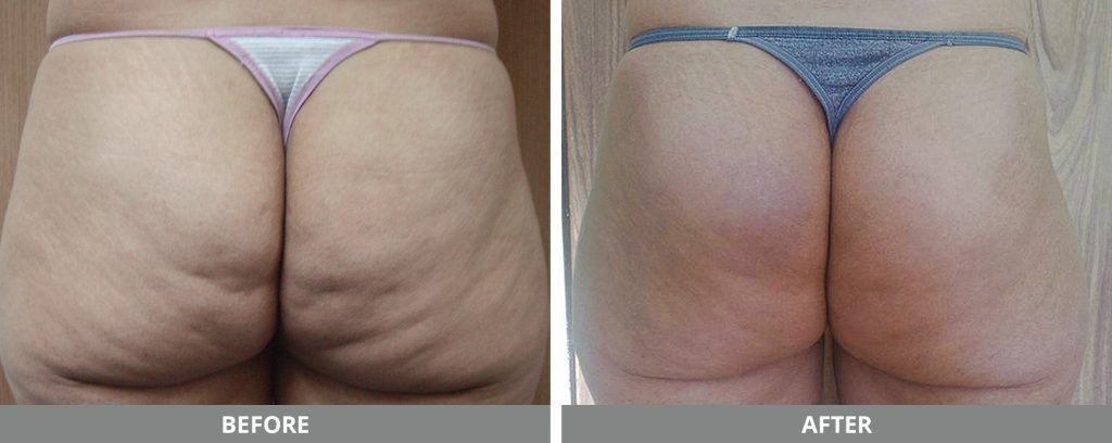Cellulite Reduction Before & After