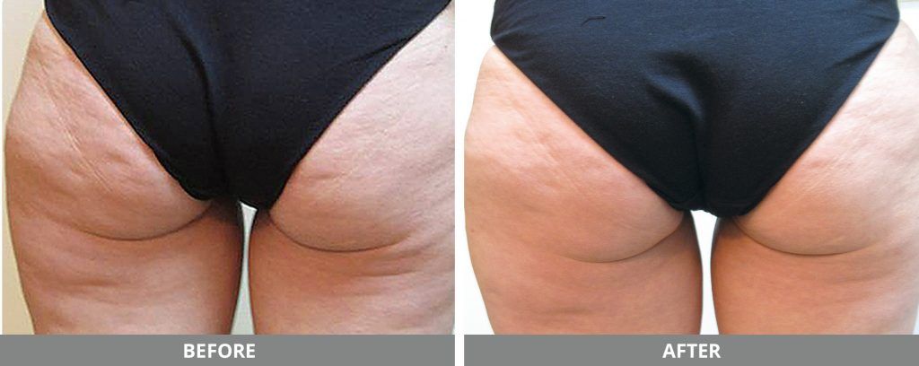 Cellulite Reduction Before & After