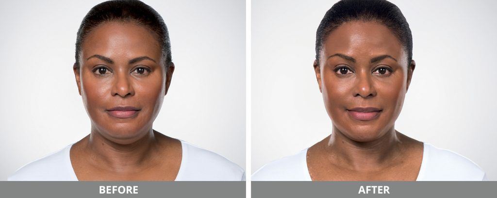 Kybella Before & After