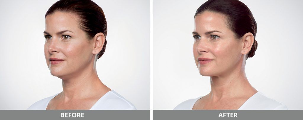 Kybella Before & After
