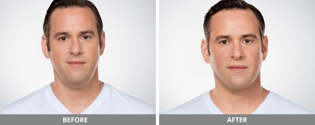 Kybella Before & After