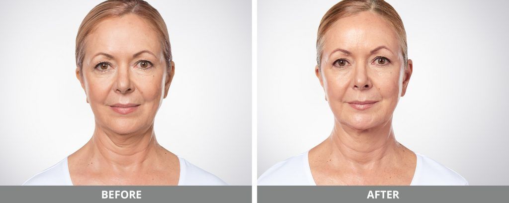 Kybella Before & After