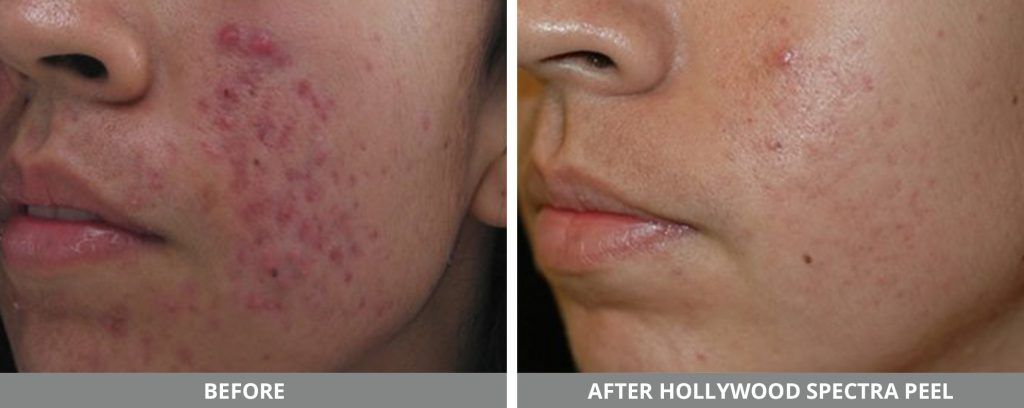 Hollywood Laser Spectra Before & After