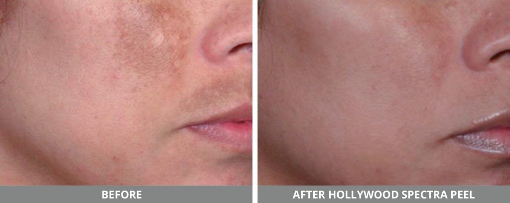 Hollywood Laser Spectra Before & After