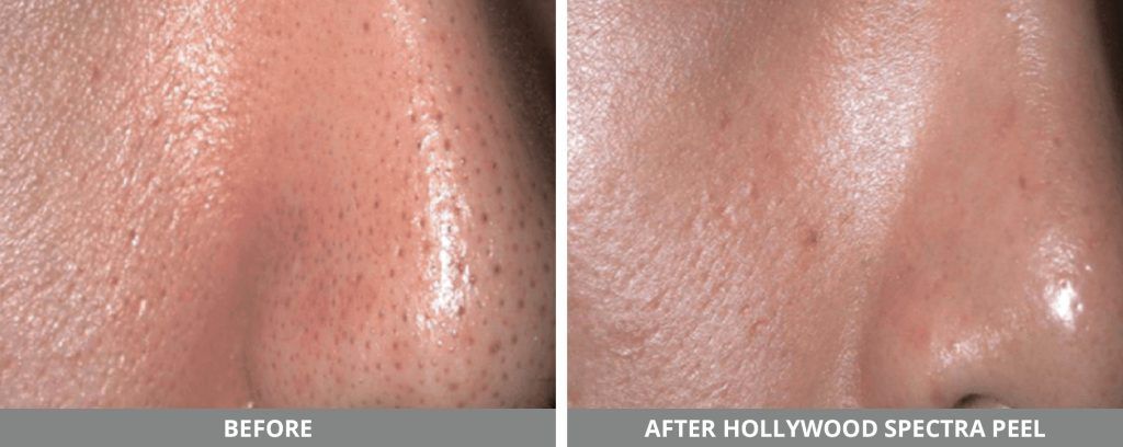 Hollywood Laser Spectra Before & After