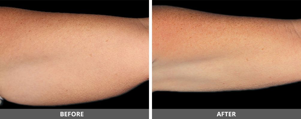 Body Sculpting Before & After