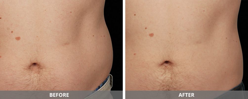 Body Sculpting Before & After