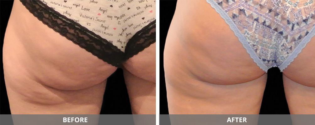 Body Sculpting Before & After