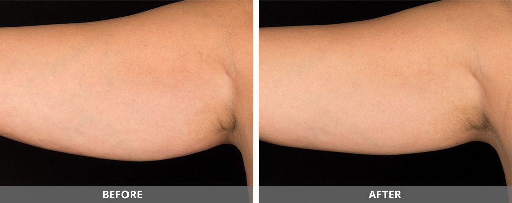 Body Sculpting Before & After