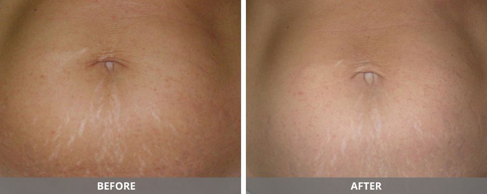 Body Sculpting Before & After