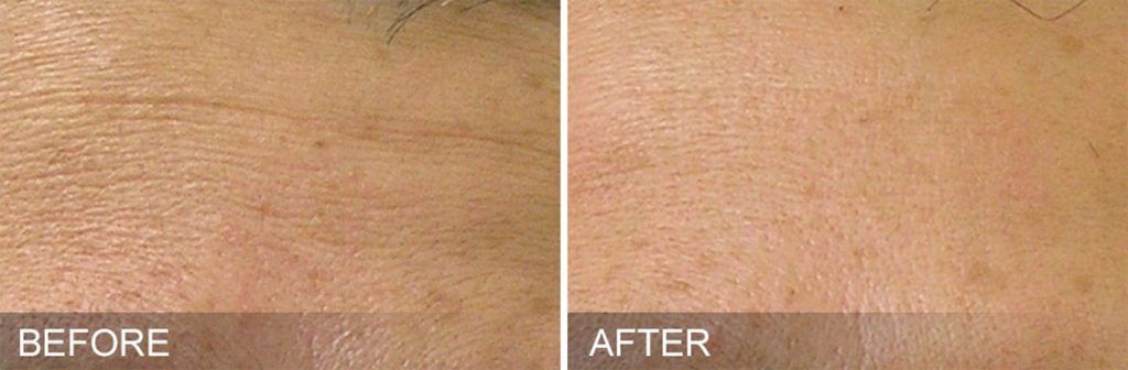 Hydrafacial Before & After