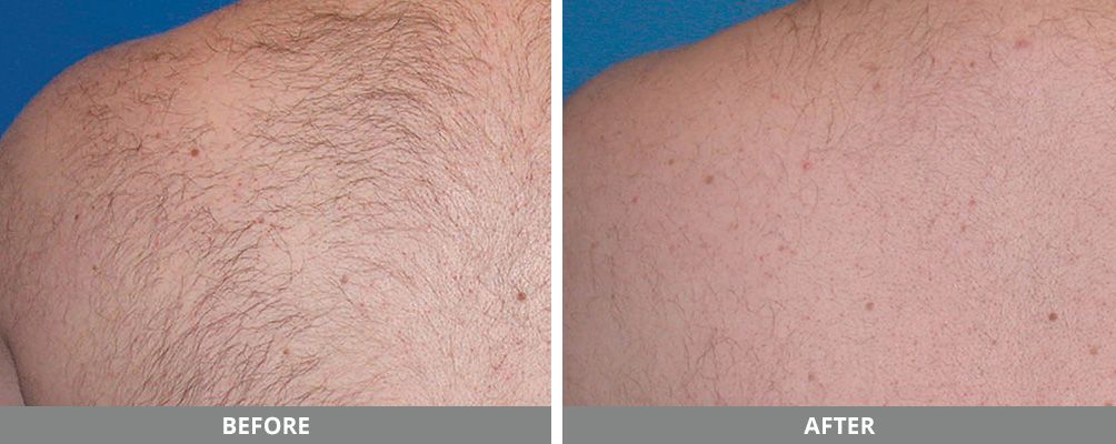 Laser Hair Removal Before & After