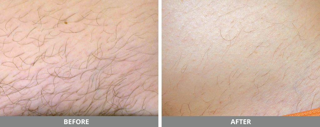 Laser Hair Removal Before & After