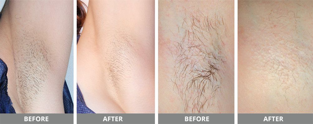 Laser Hair Removal Before & After