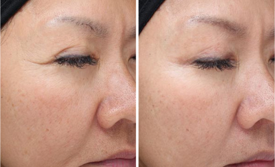 Vi Peels Before & After