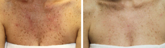 Vi Peels Before & After