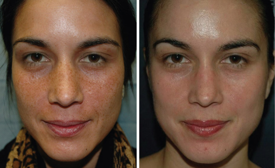 Vi Peels Before & After