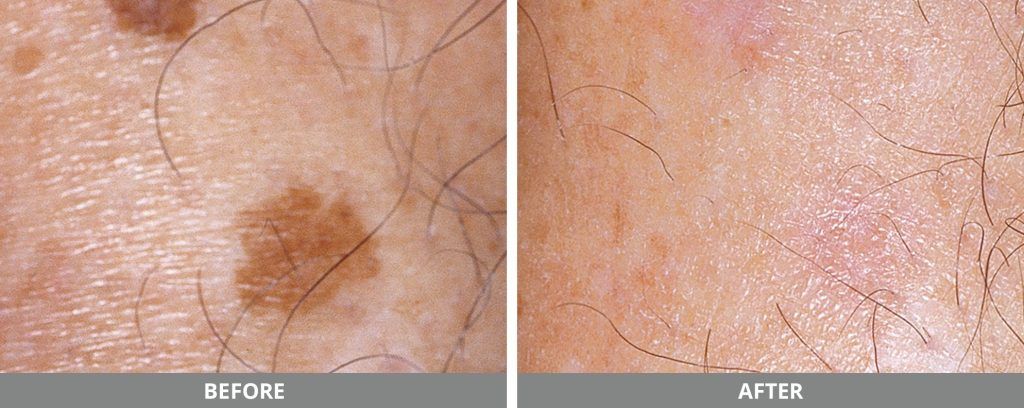 Ipl Photofacial Before & After