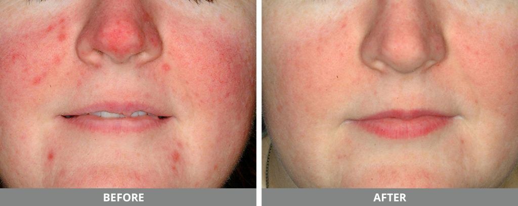 Ipl Photofacial Before & After