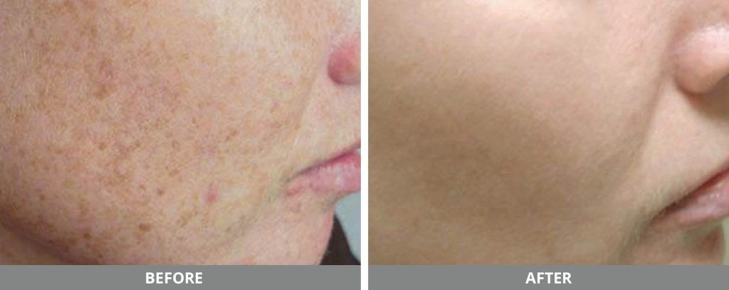 Ipl Photofacial Before & After