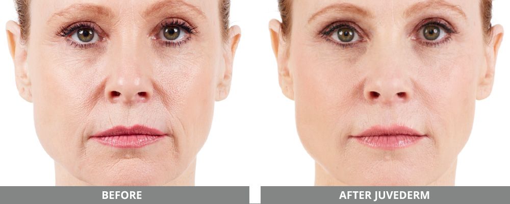Juvederm Before & After