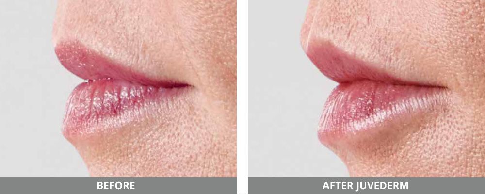 Juvederm Before & After