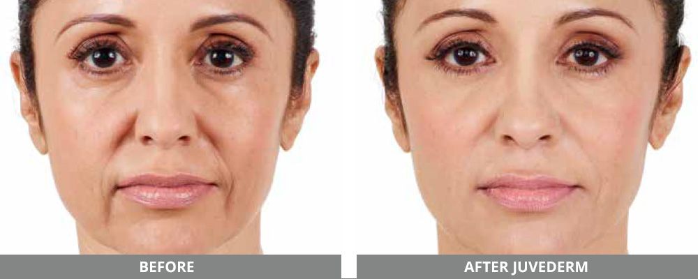 Juvederm Before & After