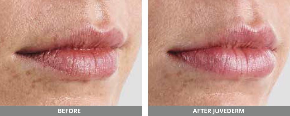 Juvederm Before & After