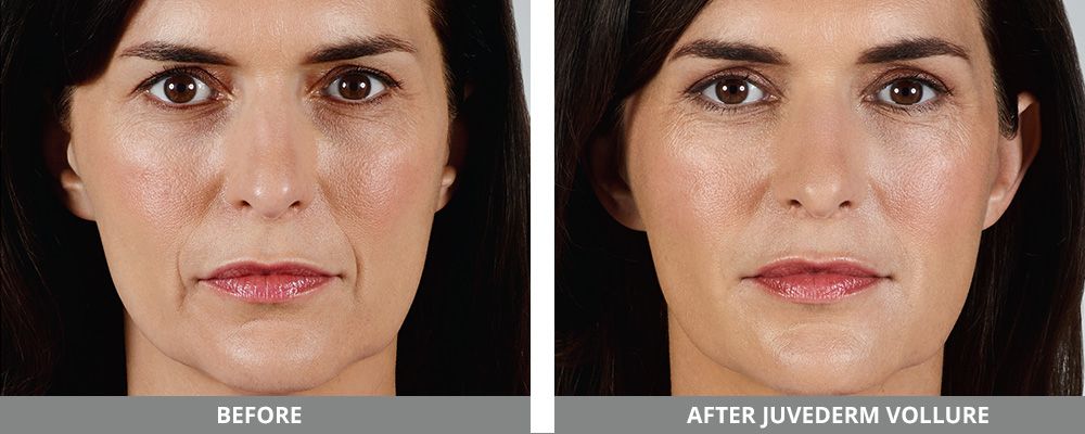 Juvederm Before & After