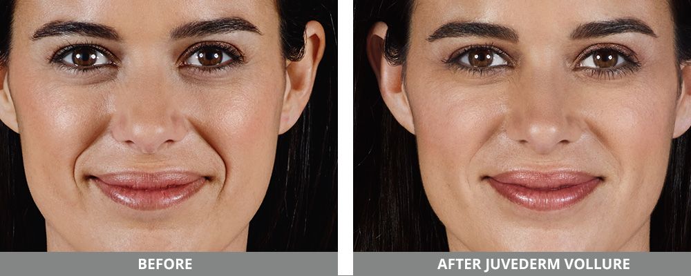 Juvederm Before & After