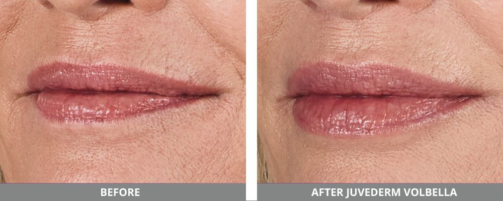Juvederm Before & After