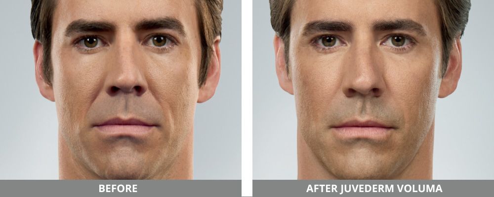 Juvederm Before & After
