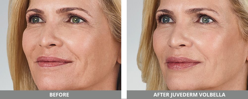 Juvederm Before & After