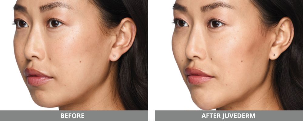 Juvederm Before & After