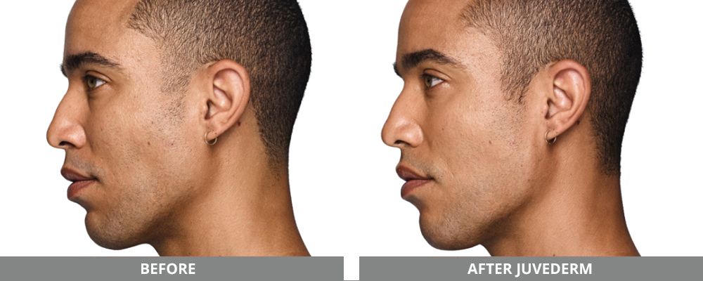 Juvederm Before & After