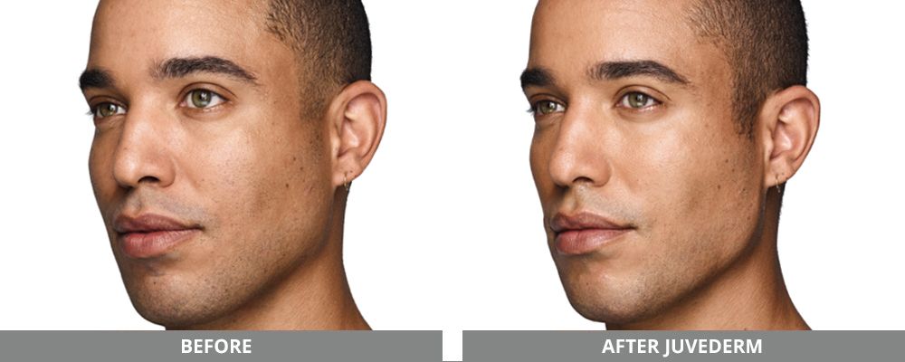Juvederm Before & After