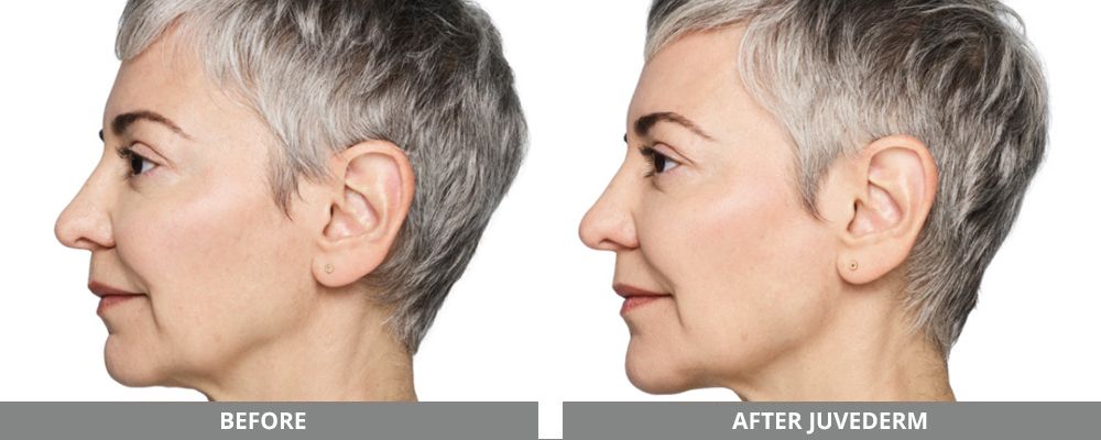 Juvederm Before & After