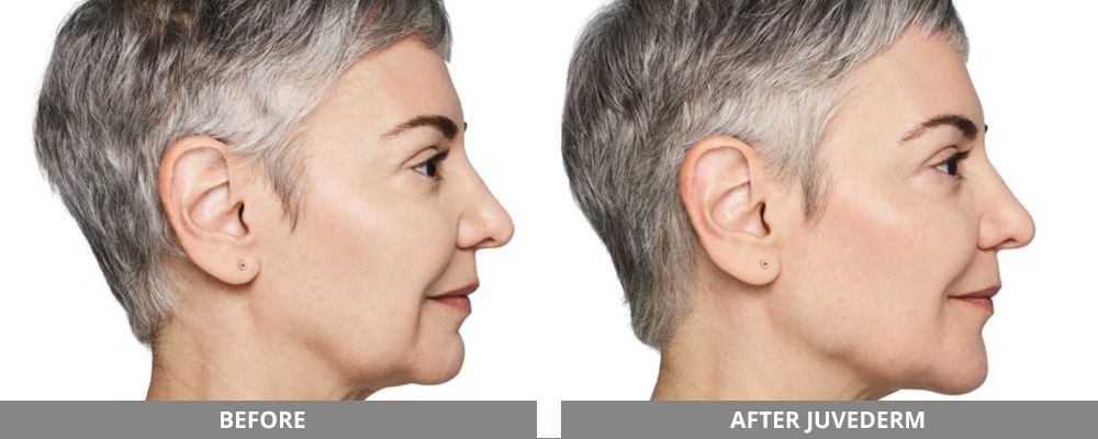 Juvederm Before & After
