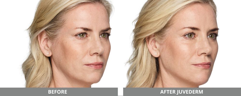 Juvederm Before & After