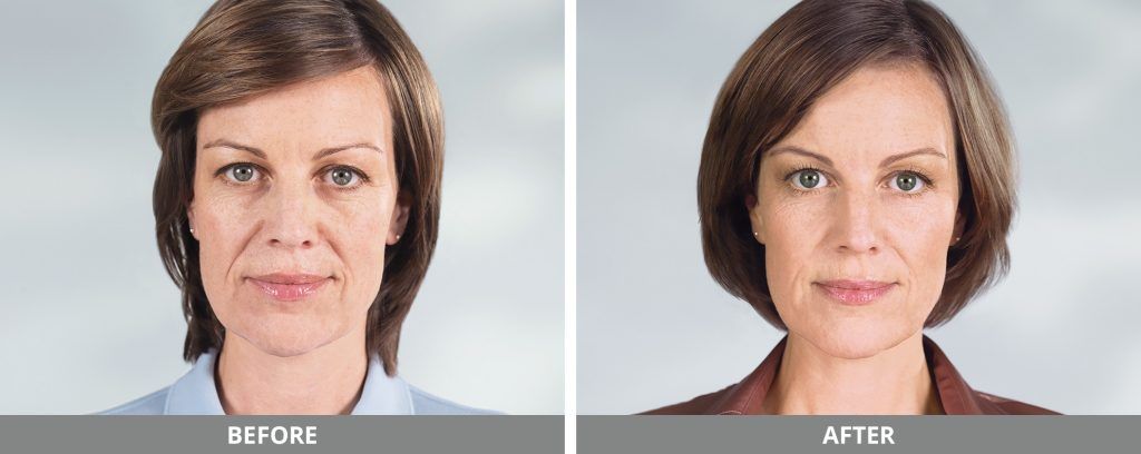 Sculptra Before & After